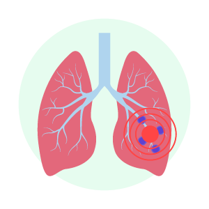 Lung cancer